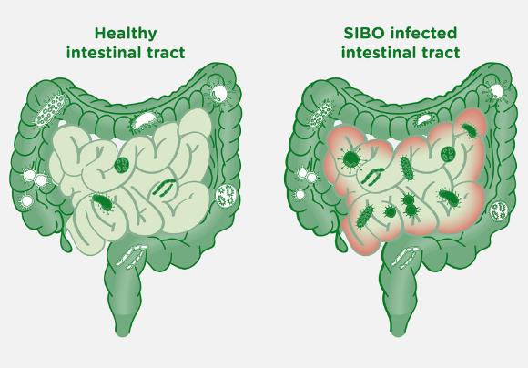 ?小肠细菌过度生长易复发或与肠动力障碍有关