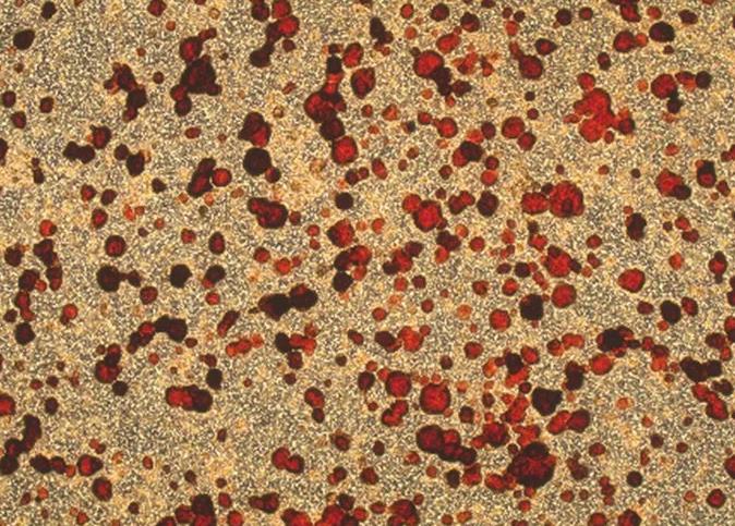 胶滴肿瘤药敏检测技术检测及评价不同药物浓度的5'-DFUR对胃癌的疗效（一）